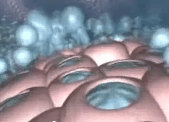 Diagram of an Ulcer 2